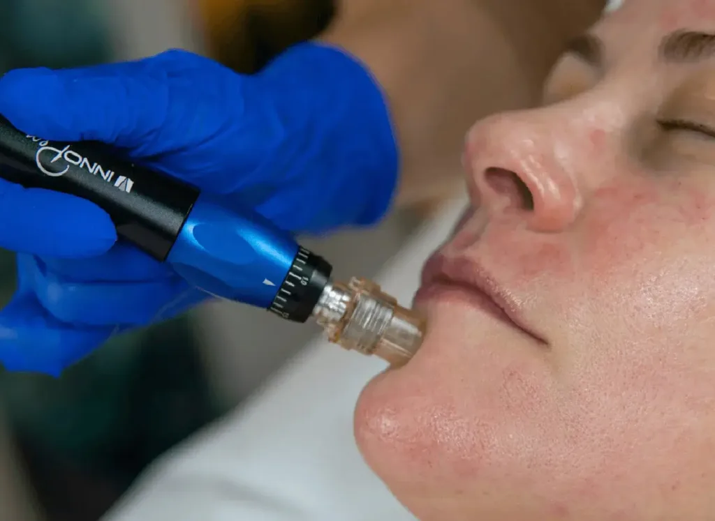 SKIN90 Facial: Environ DF Medical Needling / Microneedling Toronto